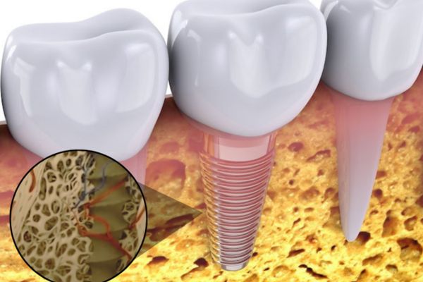 Healing / osseointegration (3–6 months)